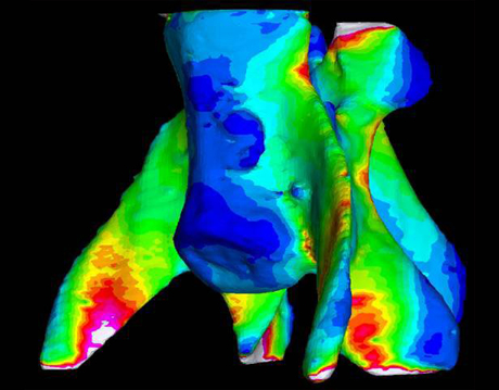 Bone-Breaking Predictions Put to the Test with FEA